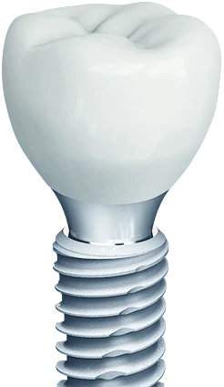 Implant modeli